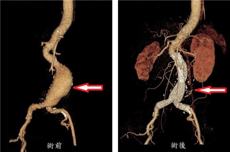 腹主動脈瘤：術前、術後比較圖